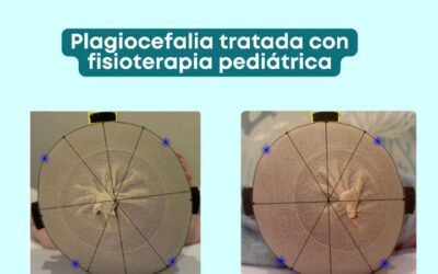 Plagiocefalia en bebés: señales de alerta y cuándo acudir al fisioterapeuta pediátrico en Córdoba | fisio h2o