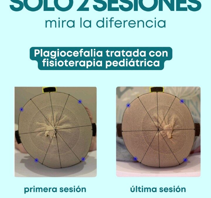 Plagiocefalia en bebés: señales de alerta y cuándo acudir al fisioterapeuta pediátrico en Córdoba | fisio h2o